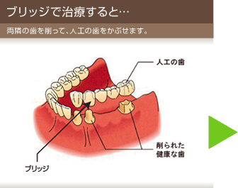 ブリッジで治療すると… 両隣の歯を削って、人工の歯をかぶせます。