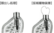 頭出し処理