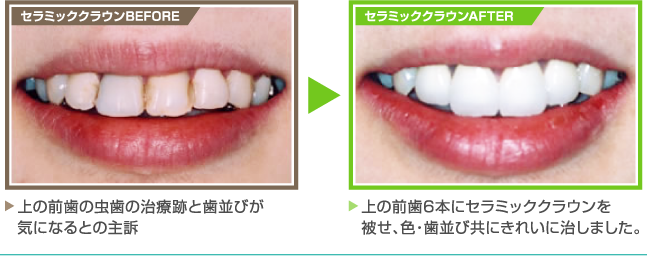 【セラミッククラウンBEFORE】上の前歯の虫歯の治療跡と歯並びが気になるとの主訴　　【セラミッククラウンAFTER】上の前歯6本にセラミッククラウンを被せ、色・歯並び共にきれいに治しました。