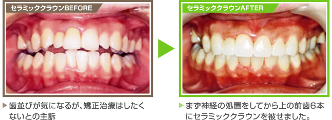 【セラミッククラウンBEFORE】歯並びが気になるが、矯正治療はしたく
ないとの主訴　　【セラミッククラウンAFTER】まず神経の処置をしてから上の前歯6本にセラミッククラウンを被せました。