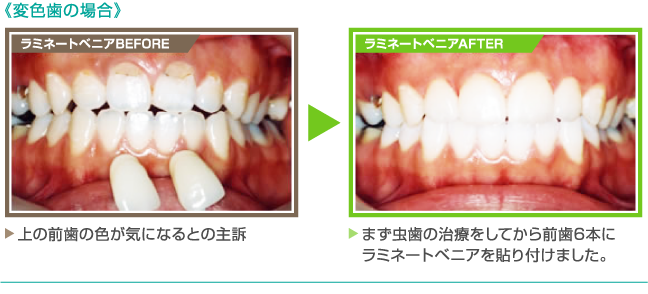 《変色歯の場合》【ラミネートベニアBEFORE】上の前歯の色が気になるとの主訴　　【ラミネートベニアAFTER】まず虫歯の治療をしてから前歯6本にラミネートベニアを貼り付けました。