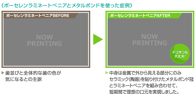 《ポーセレンラミネートべニアとメタルボンドを使った症例》【ポーセレンラミネートベニアBEFORE】歯並びと全体的な歯の色が気になるとの主訴　　【ポーセレンラミネートベニアAFTER】中身は金属で外から見える部分にのみセラミック(陶器)を貼り付けたメタルボンド冠とラミネートべニアを組み合わせて、短期間で理想の口元を実現しました。