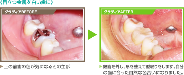 《目立つ金属を白い歯に》【グラディアBEFORE】上の前歯の色が気になるとの主訴　　【グラディアAFTER】銀歯を外し、形を整えて型取りをします。自分の歯に合った自然な色合いになりました。