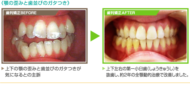 《顎の歪みと歯並びのガタつき》【歯列矯正BEFORE】上下の顎の歪みと歯並びのガタつきが気になるとの主訴　　【歯列矯正AFTER】上下左右の第一小臼歯（しょうきゅうし）を抜歯し、約2年の全顎動的治療で改善しました。