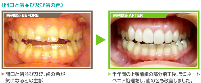 《開口と歯並び及び歯の色》【歯列矯正BEFORE】開口と歯並び及び、歯の色が気になるとの主訴　　【歯列矯正AFTER】半年間の上顎前歯の部分矯正後、ラミネートベニア処理をし、歯の色も改善しました。