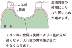 ・超硬質歯の使用により、より固いものが噛めます。　・チタン等の金属床使用により、口蓋部分が薄くなり、入れ歯の異物感がさらに少なくなります。