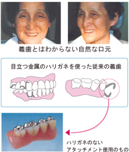 義歯とはわからない自然な口元